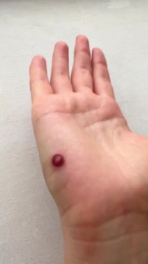 İnsan elinin üzerinde büyük bir siğil var.