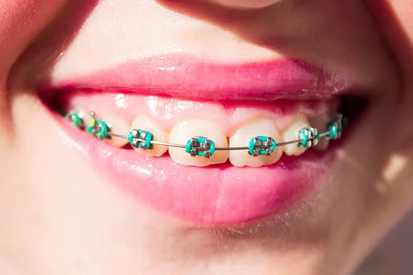 Smiling girl with braces — Stock Photo, Image