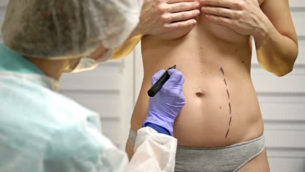 Estetik cerrah bir hastayı liposuction ameliyatı için hazırlar. Doktor, kadın vücuduna işaretle çizgiler çizer.. — Stok video