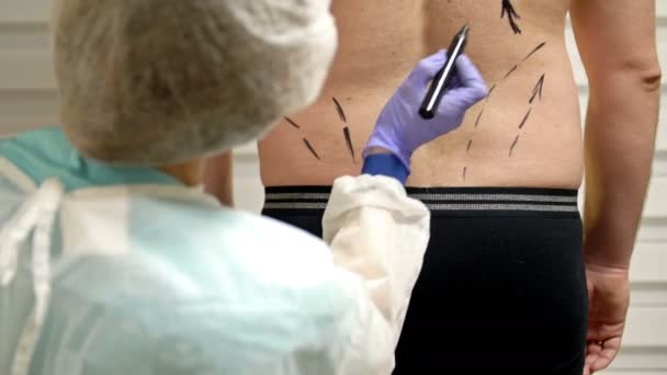 Der plastische Chirurg bereitet einen Patienten auf eine Fettabsaugung vor. Arzt zeichnet mit Marker Linien auf den männlichen Körper. — Stockvideo