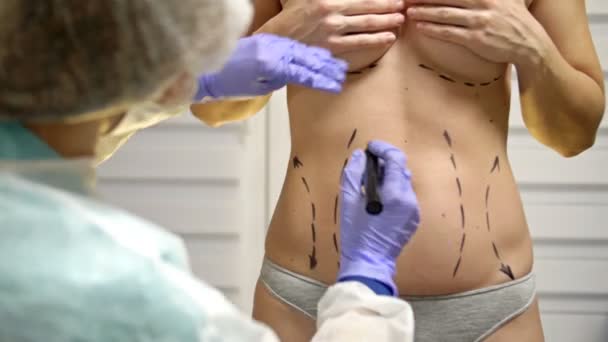 A plasztikai sebész felkészíti a beteget a zsírleszívásra. Az orvos megrajzolja a vonalat a női testen egy filctollal.. — Stock videók