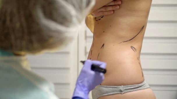 Plastic surgeon prepares a patient for liposuction surgery. Doctor draws lines on the female body with a marker. — Stock Video