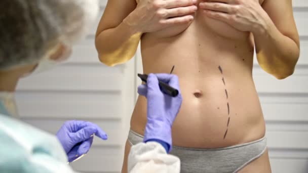 Plastický chirurg připravuje pacienta na liposukci. Doktor kreslí čáry na ženské tělo značkovačem. — Stock video