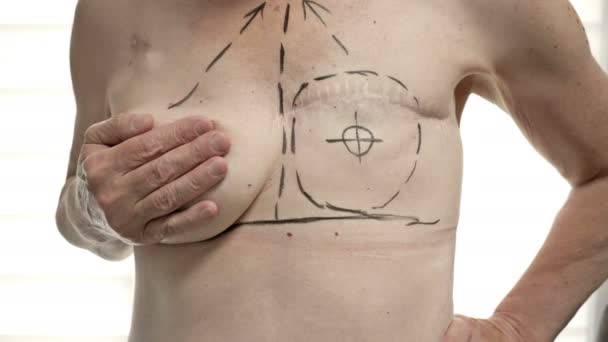 Mempersiapkan rekonstruksi payudara bagi seorang wanita yang menjalani mastektomi. Operasi plastik payudara setelah mastektomi. — Stok Video