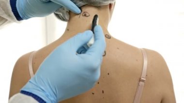 Dermatolog hastaları muayene eder, benlerini çıkarır ve alınması gerekenleri işaretler..