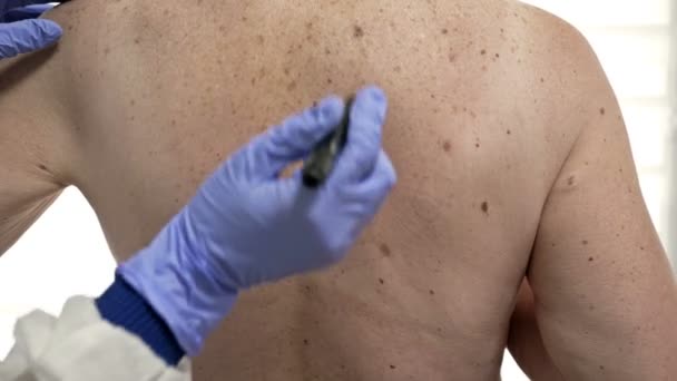 Dermatolog bada krety pacjentów i zaznacza te, które mają być usunięte. — Wideo stockowe