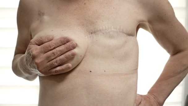 Göğüs ameliyatına hazırlanan bir kadın için mastektomi. Göğüs estetiği ameliyatından sonra mastektomi. — Stok video