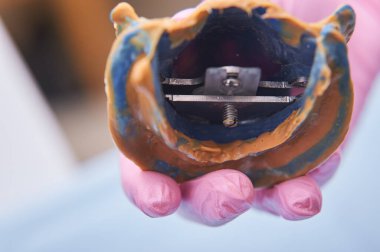 Diş ameliyatı. Diş teknisyeni takma diş yapıyor. Protez işe yaramadan önce diş protezi tıbbi ellerde..