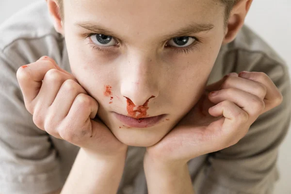 Boy with Nose Bleed Staring Up at Camera — Stock Photo, Image