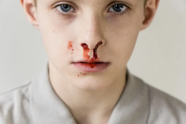 鼻血を出した少年はカメラをぼんやりと見つめる — ストック写真