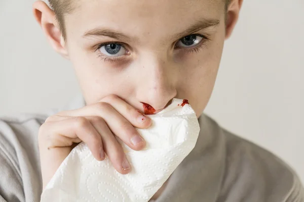 Un chico serio usa tejido para detener la hemorragia nasal — Foto de Stock