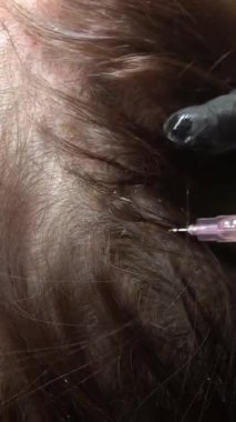 Doktor sağlıklı saç büyümesi için plazma terapisi uygular. Profesyonel tıp çalışanı, plazma tedavisi için küçük şırınga iğnesi kullanır. Güzellik, sağlık ve cilt bakımı. 4k video.