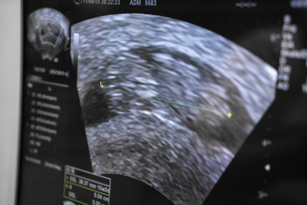 Акушерская ультразвуковая диагностика нерожденного плода
