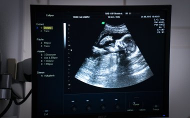 Fetus obstetrik ultrason