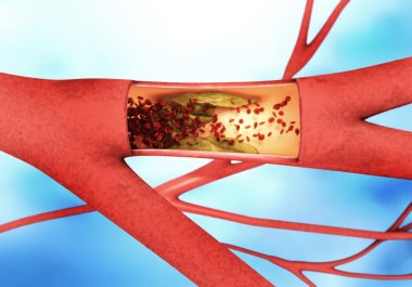 Precipitating and narrowing of the blood vessels - arteriosclerosis clipart