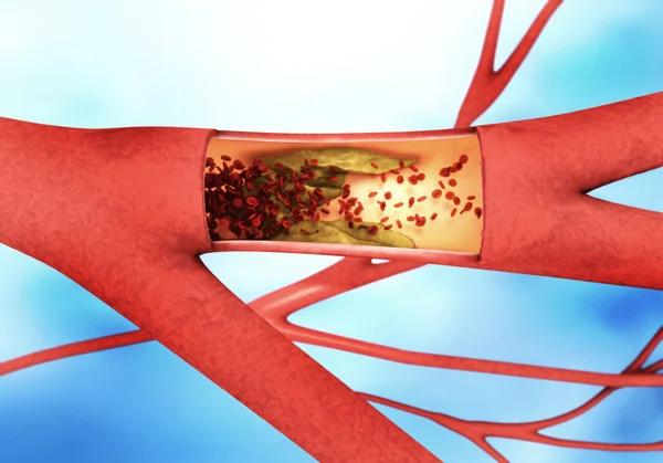 Precipitación y estrechamiento de los vasos sanguíneos - arteriosclerosis — Foto de Stock