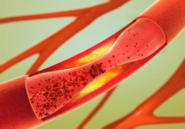 Precipitar e estreitamento dos vasos sanguíneos - arteriosclerose — Fotografia de Stock