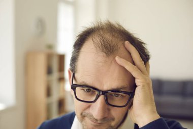 Balding middle aged man concerned about hair loss touches bald spots on his head clipart