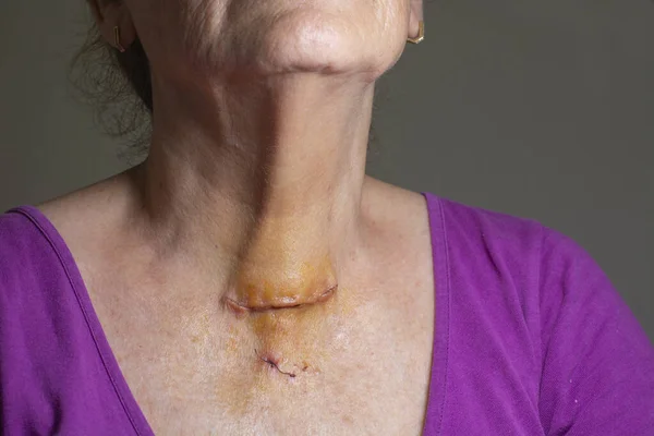 Post surgical scar on woman neck after thyroid surgery