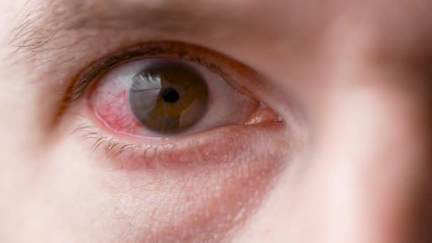 Um homem com um olho vermelho e dolorido. Uma infecção durante a doença atingiu os olhos. — Vídeo de Stock