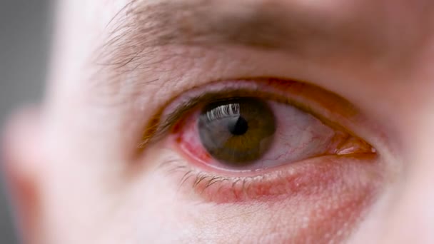 Un hombre con un ojo rojo y dolorido. Una infección durante la enfermedad golpeó los ojos. — Vídeos de Stock