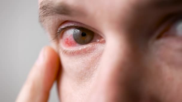Un hombre con un ojo rojo y dolorido. Una infección durante la enfermedad golpeó los ojos. — Vídeos de Stock