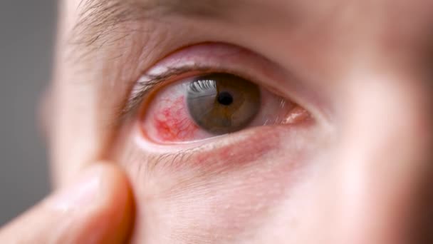 Ein Mann mit einem roten, schmerzenden Auge. Eine Infektion während der Krankheit traf die Augen. — Stockvideo
