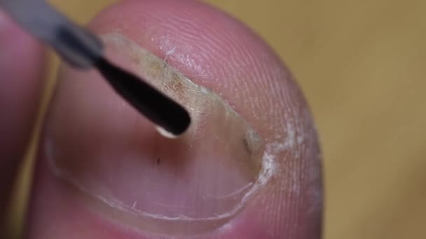 Lesiones fúngicas. Tratamiento de las uñas de los pies en un hombre mayor. — Vídeos de Stock