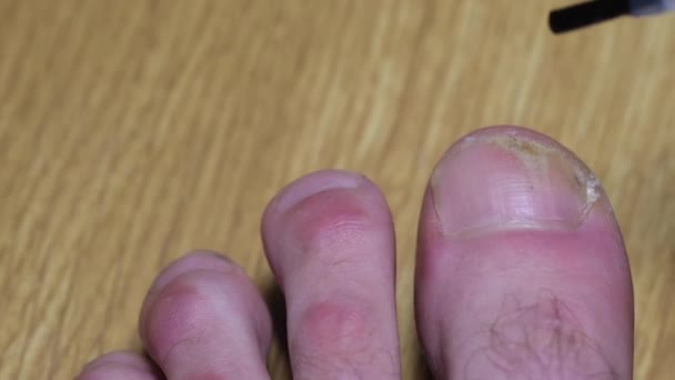 Treatment of a diseased toenail. Nail fungus close up. — Stock videók