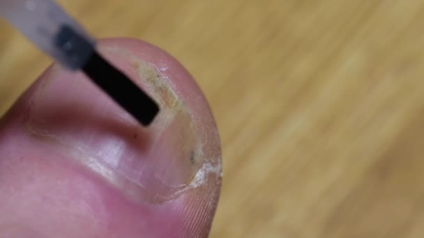 Закрыть грибковую инфекцию ногтей. Применение грибкового лака для ногтей. — стоковое видео