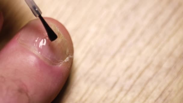 Muž aplikuje antimykotika na infikovaný palec. — Stock video