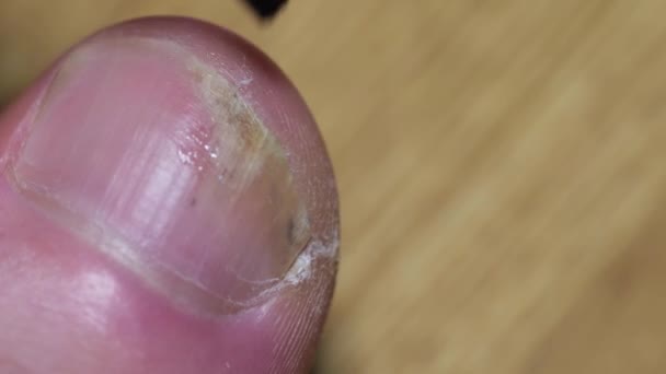한 남자가 큰 발가락에 곰팡이를 치료하고 있어요. 달팽이 병. — 비디오