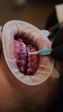 Profesyonel diş hijyenisti ortodontik diş tellerinin etrafındaki diş fırçalarını göstererek uygun ağız hijyeni tekniğini sergiliyor.