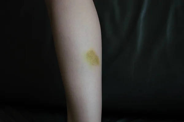 Blåmärken hud, ett ben med smärta — Stockfoto