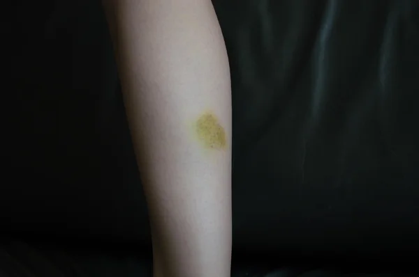 Bruised skin, a leg with pain — Stock Photo, Image