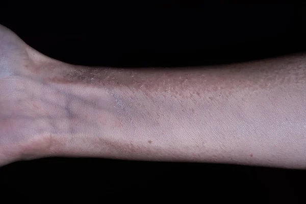 Обрезанный Вид Женской Руки Мертвой Отшелушенной Кожей Изолированной Черном Фоне — стоковое фото
