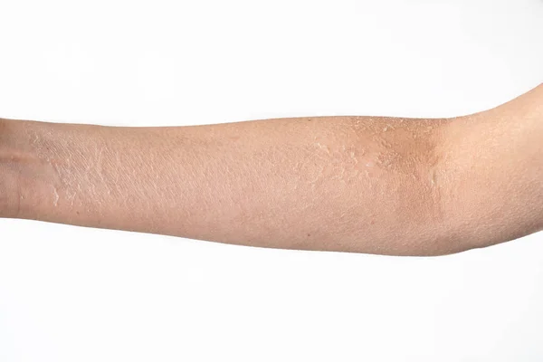 Обрезанный Вид Женской Руки Мертвой Отшелушенной Кожей Изолированной Белом Фоне — стоковое фото
