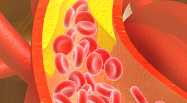 Tıkanmış arterden kan akışı. 3d illüstrasyon