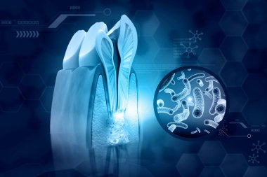İnsan dişi kesiti. Çürükler, diş çürükleri. 3d illüstrasyon