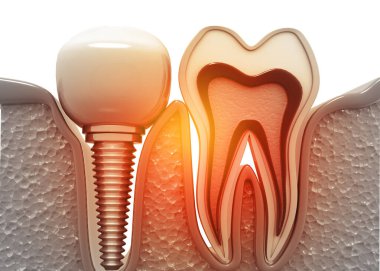 Dental implant and cross section of tooth. 3d illustration