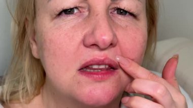 herpes on the lip in a woman face with an injury on the lip caused by a herpes virus. They are touching the affected area and examining it. High quality 4k footage