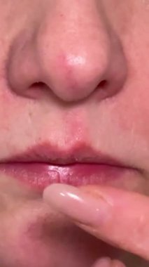 Hasta dudaklarını soğuk ve uçukla kontrol eden bir kadın. Acı verici bir kızarıklık ve kızarıklık. Bağışıklığı, alerjisi ve hastalığı azalmış. Yüksek kalite 4k görüntü