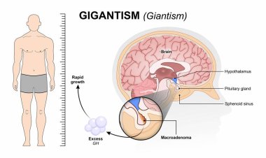Devlik - Dev Flaşkart Tıbbi Hastalık