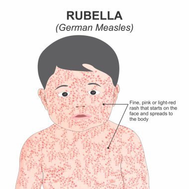 Rubella (German Measles) Flashcard Illustration