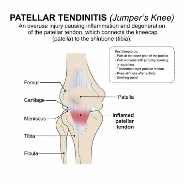 Patellar Tendinit (Jumpers Diz) Flashcard