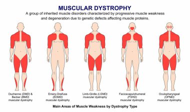 Kas Disrofisi Tipleri Flashcard İllüstrasyonu