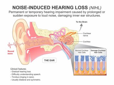 Gürültüye bağlı İşitme Kaybı (NIHL)