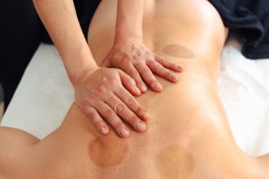 Terapist, gözle görülür kupa izleri, sağlık merkezindeki rahatlama tedavisi, sağlık ve iyileşme için alternatif tıp ve vücut bakımı terapisi yapan kişiye terapi uyguluyor.