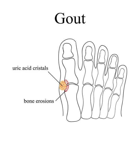 Diagram of gout in human toe illustration — Stock Vector