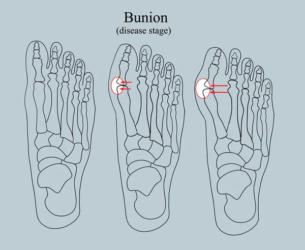 Bunion, estágio da doença —  Vetores de Stock